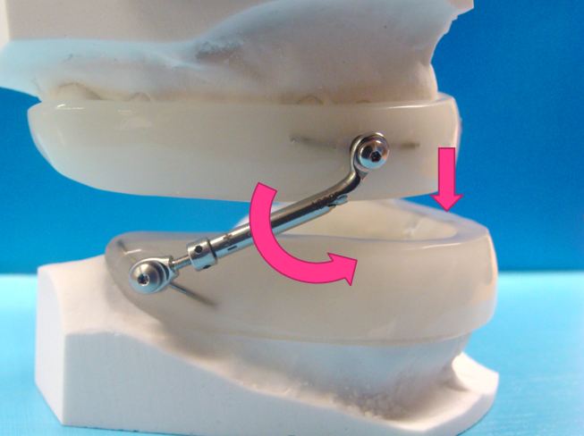 Dispositivo de avance mandibular Pul